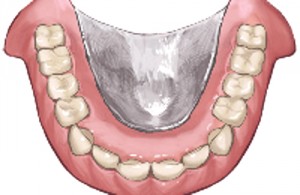 総入れ歯