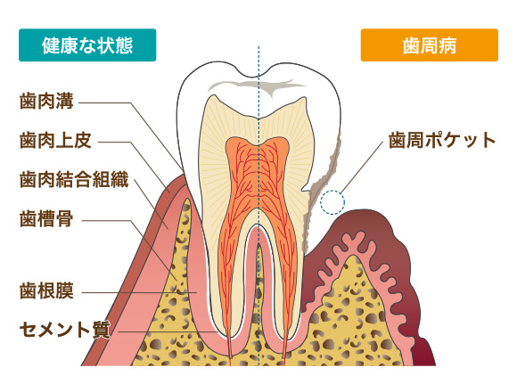 歯周病の進行